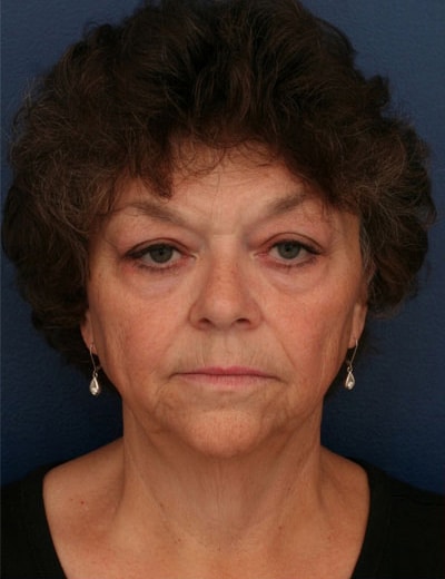 Before Image: Chin Surgery - front