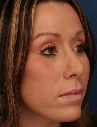 After Image: Chin Surgery - right-front-oblique