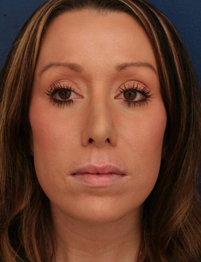 After Image: Chin Surgery - front