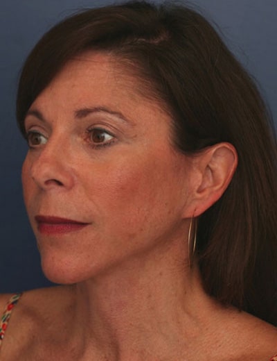 After Image: Chin Surgery - left-front-oblique