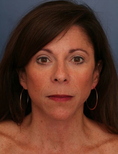 After Image: Chin Surgery - front