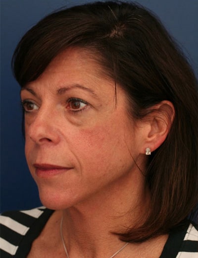 Before Image: Chin Surgery - left-front-oblique