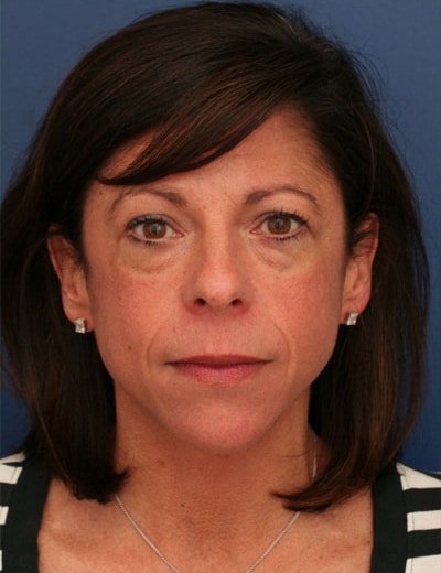Before Image: Chin Surgery - front