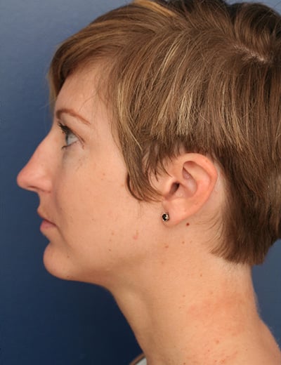 After Image: Chin Surgery - left-side