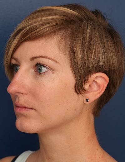 After Image: Chin Surgery - left-front-oblique