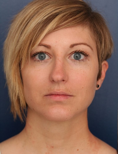 After Image: Chin Surgery - front