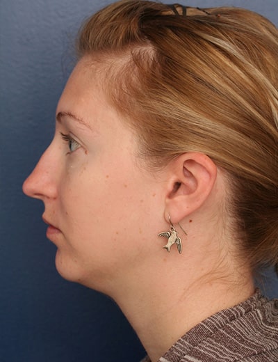 Before Image: Chin Surgery - left-side