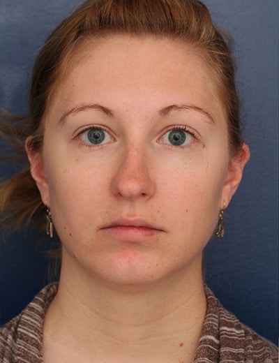 Before Image: Chin Surgery - front