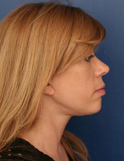 After Image: Chin Surgery - right-side