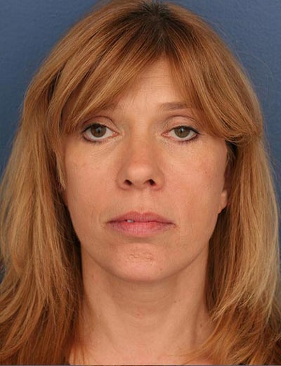 After Image: Chin Surgery - front