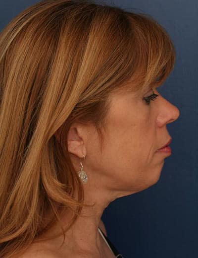 Before Image: Chin Surgery - right-side