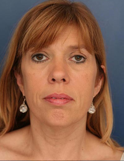 Before Image: Chin Surgery - front