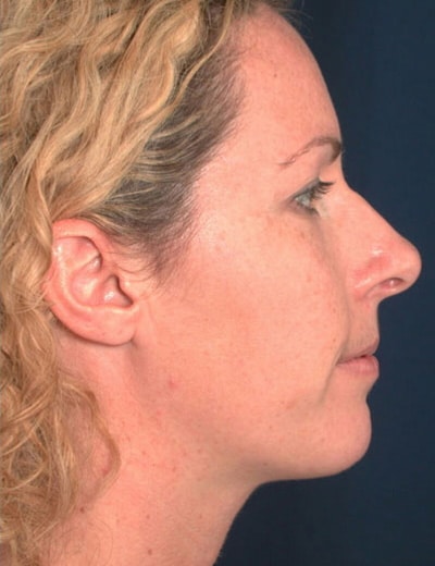 After Image: Chin Surgery - right-side
