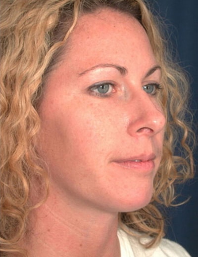 After Image: Chin Surgery - right-front-oblique
