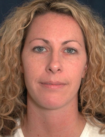 After Image: Chin Surgery - front