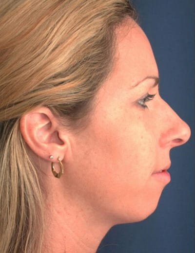 Before Image: Chin Surgery - right-side