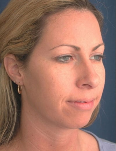 Before Image: Chin Surgery - right-front-oblique