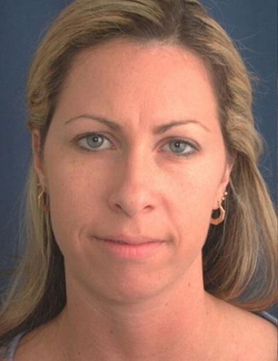 Before Image: Chin Surgery - front