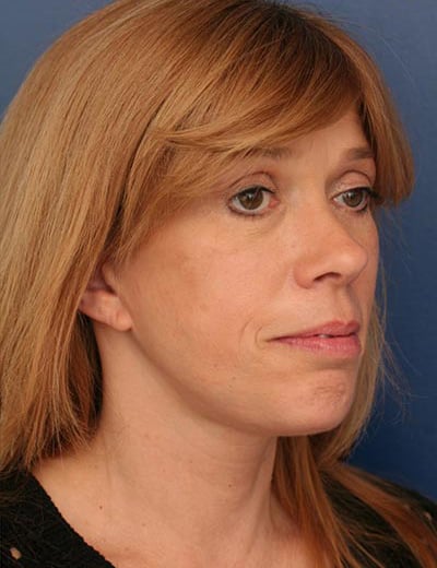 After Image: Facelift - right-front-oblique