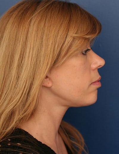 After Image: Facelift - right-side