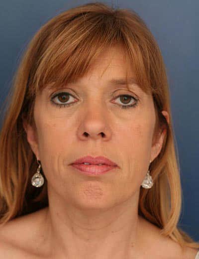 Before Image: Facelift - front