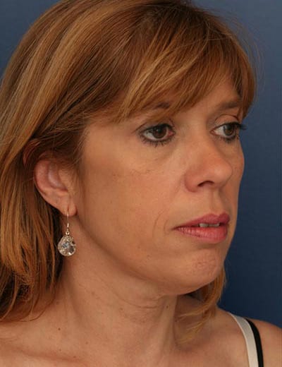 Before Image: Facelift - right-front-oblique
