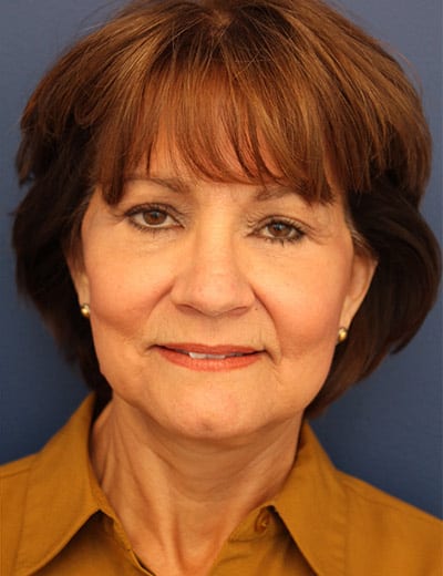 After Image: Facelift - front