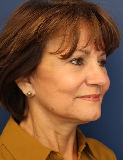 After Image: Facelift - right-front-oblique
