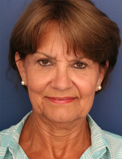 Before Image: Facelift - front