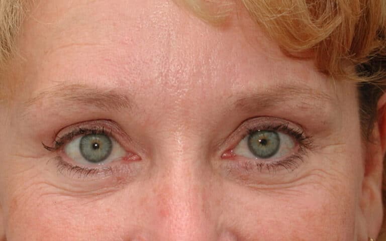 After Image: Eyelid Surgery - front