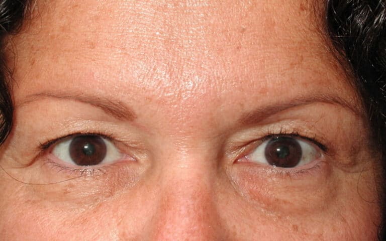 Before Image: Eyelid Surgery - front