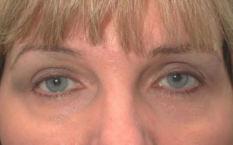 After Image: Eyelid Surgery - front