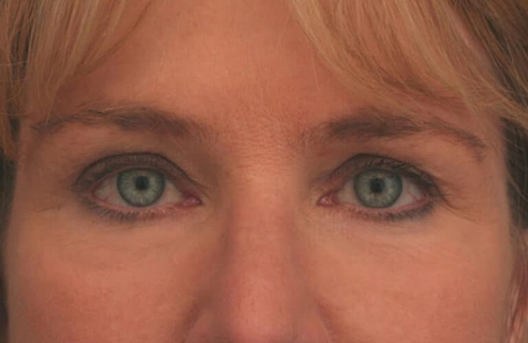 After Image: Eyelid Surgery - front
