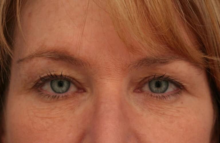 Before Image: Eyelid Surgery - front