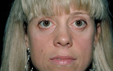 After Image: Eyelid Surgery - front