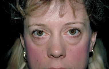 Before Image: Eyelid Surgery - front