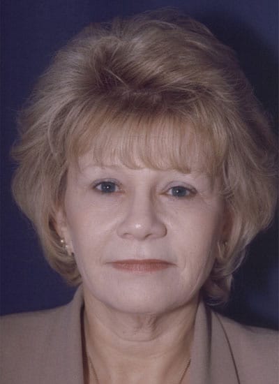 After Image: Eyelid Surgery - front