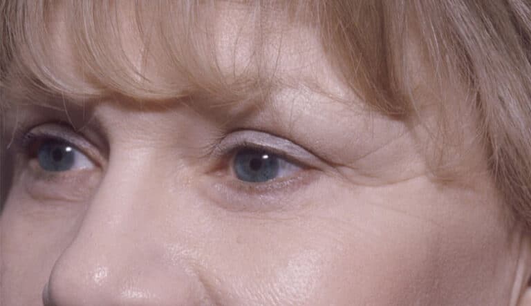 After Image: Eyelid Surgery - left-front-oblique