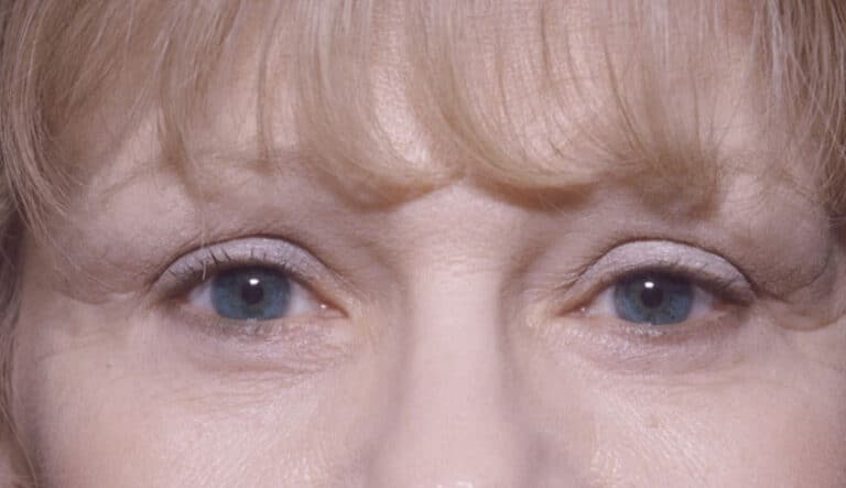 After Image: Eyelid Surgery - front