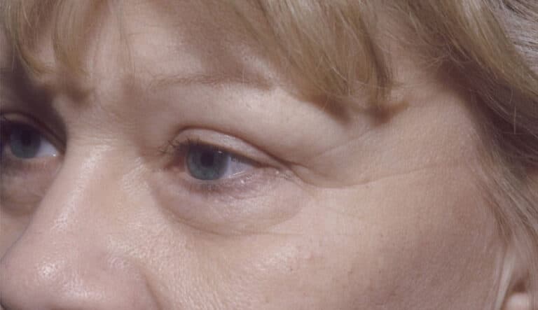 Before Image: Eyelid Surgery - left-front-oblique