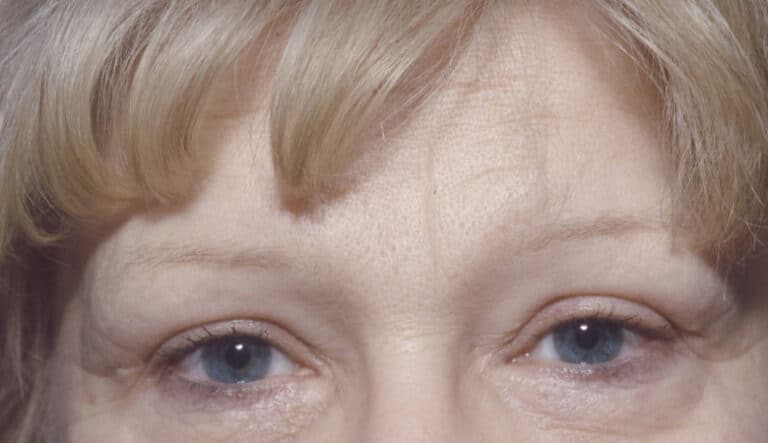 Before Image: Eyelid Surgery - front