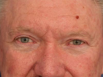 After Image: Eyelid Surgery - front