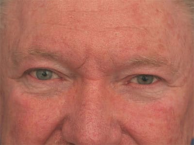 Before Image: Eyelid Surgery - front