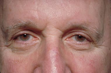 After Image: Eyelid Surgery - front