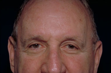 After Image: Eyelid Surgery - front