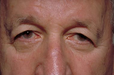Before Image: Eyelid Surgery - front