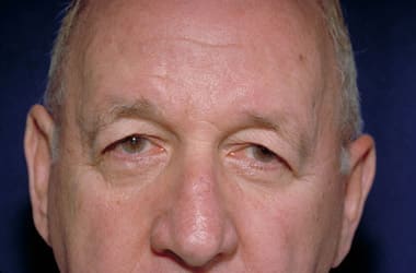 Before Image: Eyelid Surgery - front