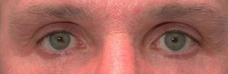 After Image: Eyelid Surgery - front