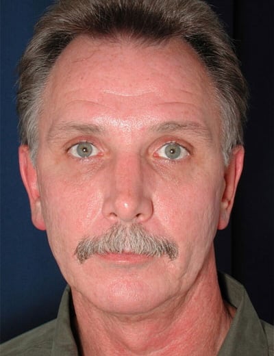 Before Image: Eyelid Surgery - front