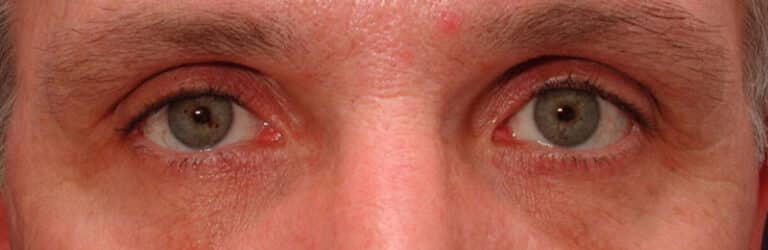 Before Image: Eyelid Surgery - front